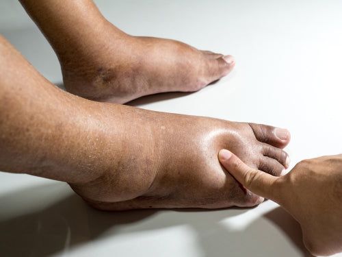 Edema: Causes, Symptoms and Treatment